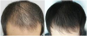 Волосы до и после мезотерапии